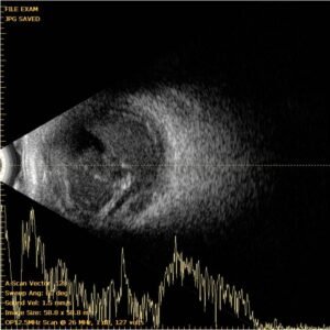 SCANNER D'ÉCHOGRAPHIE OPHTALMIQUE Échographe ophtalmique